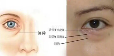 去眼袋手术