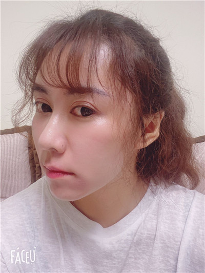 去眼袋手术