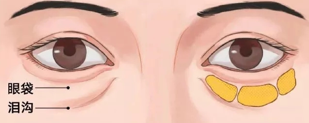 去眼袋手术