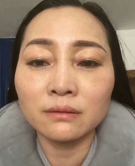 去眼袋手术