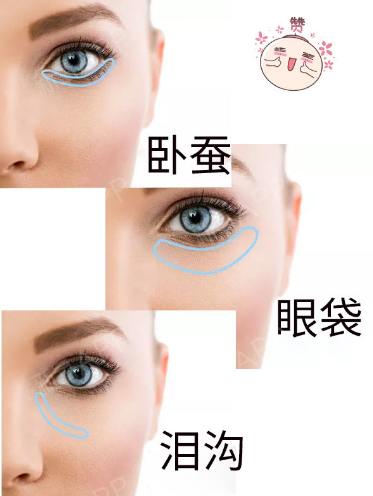 去眼袋手术