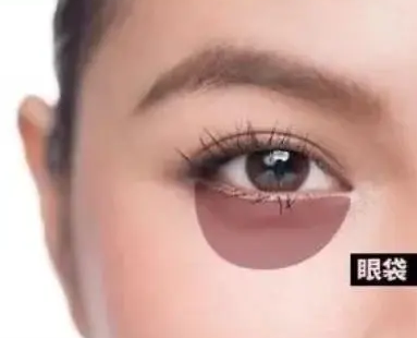 去眼袋手术