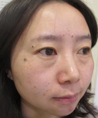 去眼袋手术