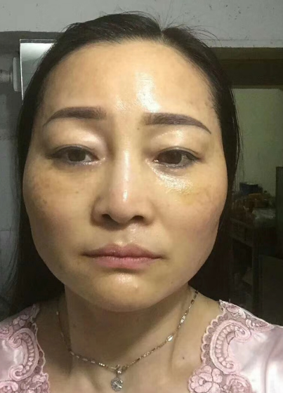 去眼袋手术