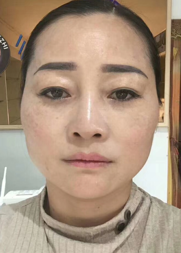 去眼袋手术