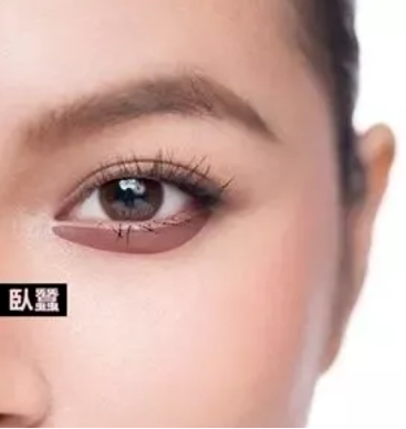去眼袋手术