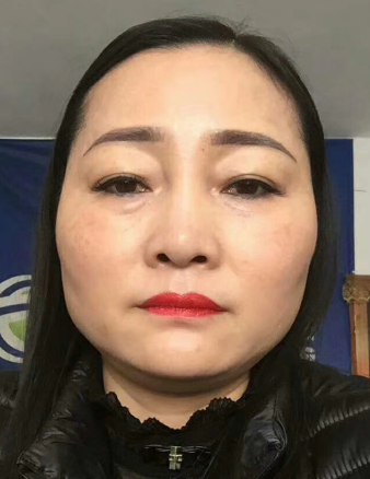 去眼袋手术