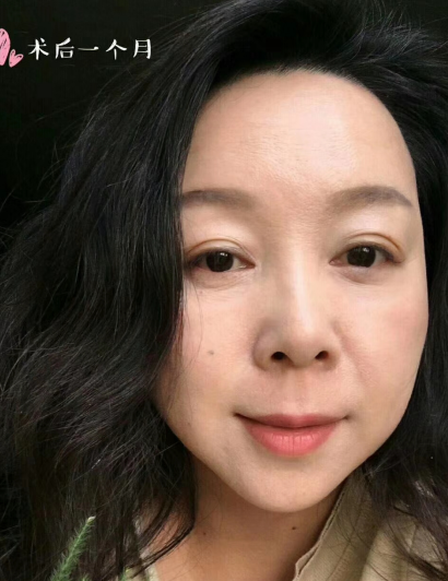 去眼袋手术