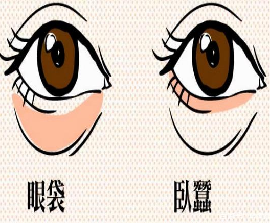 去眼袋手术