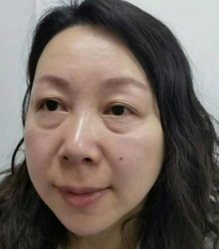去眼袋手术