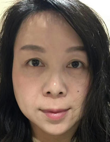 去眼袋手术