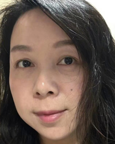 去眼袋手术