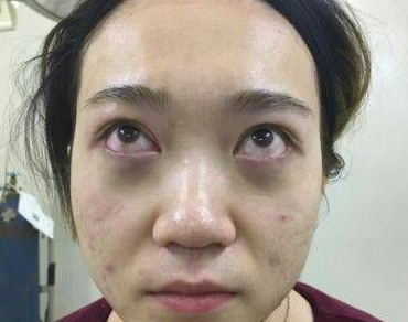 去眼袋手术