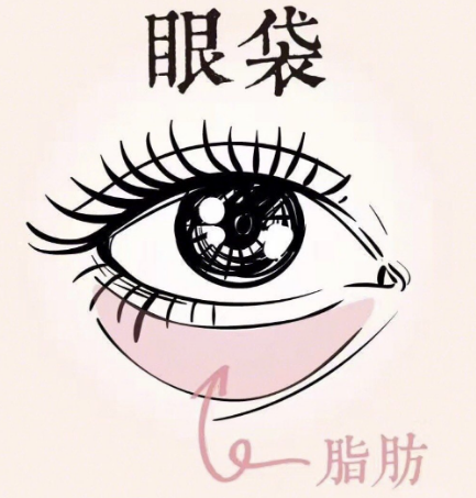 去眼袋手术