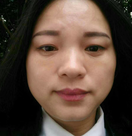 去眼袋手术