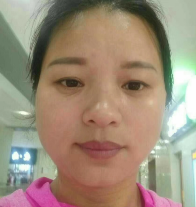 去眼袋手术