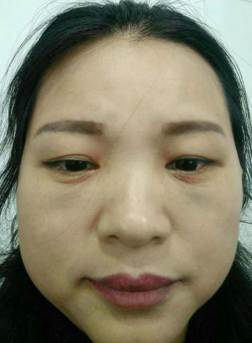 去眼袋手术