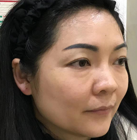去眼袋手术