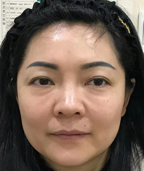 去眼袋手术