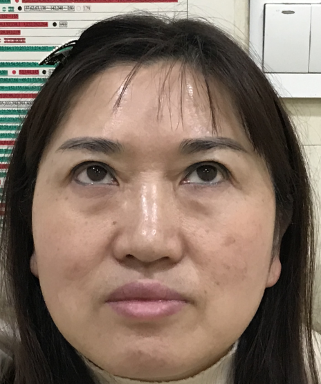 去眼袋手术