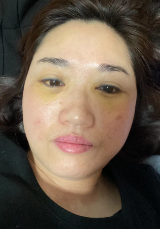 去眼袋手术