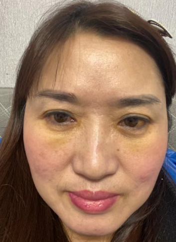 去眼袋手术