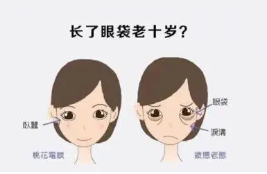 去眼袋手术