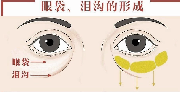 去眼袋手术