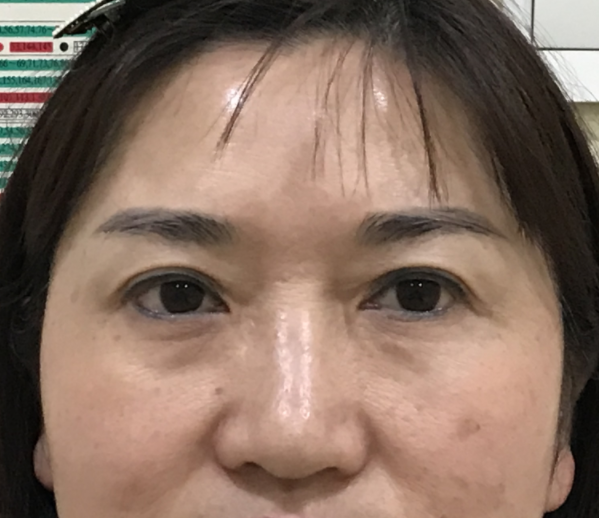 ☆怎么治眼袋保质期更好?哪里可以做?046 ☆怎么治眼袋保质期更好?哪里可以做?046