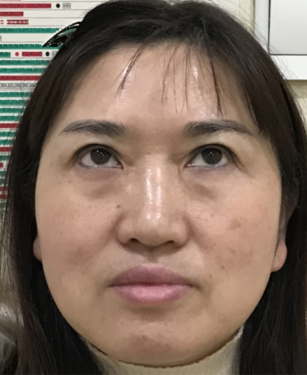 ☆怎么治眼袋保质期更好?哪里可以做?046 ☆怎么治眼袋保质期更好?哪里可以做?046