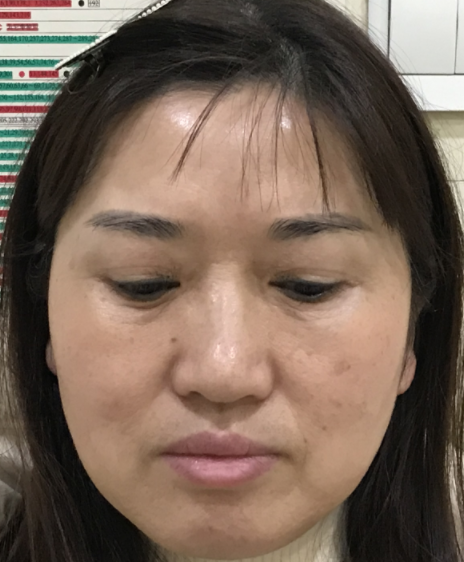 ☆怎么治眼袋保质期更好?哪里可以做?046 ☆怎么治眼袋保质期更好?哪里可以做?046