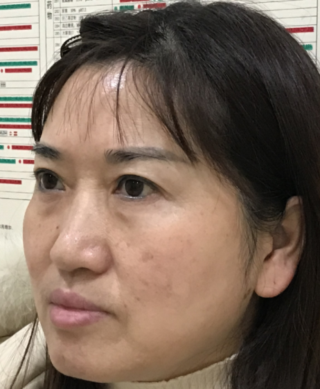☆怎么治眼袋保质期更好?哪里可以做?046 ☆怎么治眼袋保质期更好?哪里可以做?046