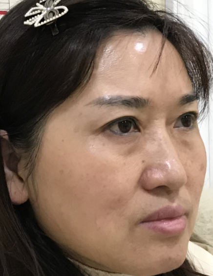 ☆怎么治眼袋保质期更好?哪里可以做?046 ☆怎么治眼袋保质期更好?哪里可以做?046