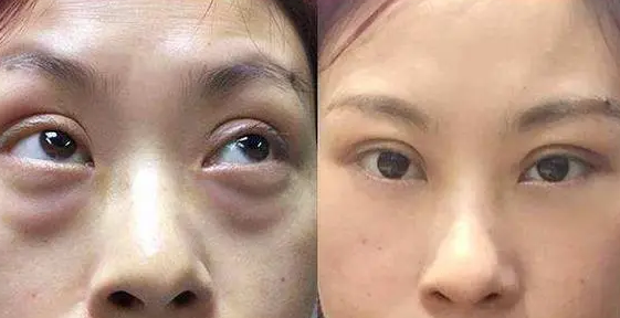 ☆怎么治眼袋保质期更好?哪里可以做?046 ☆怎么治眼袋保质期更好?哪里可以做?046