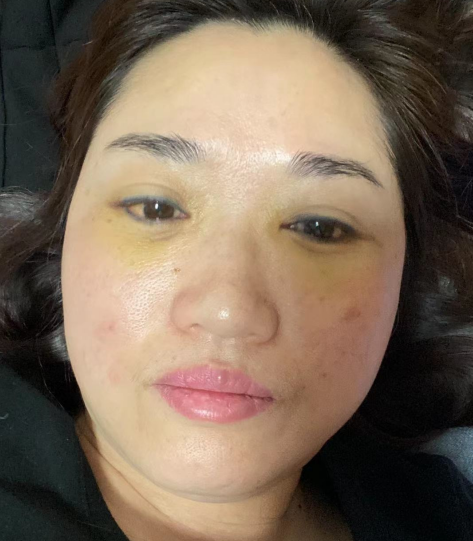 ☆怎么治眼袋保质期更好?哪里可以做?046 ☆怎么治眼袋保质期更好?哪里可以做?046