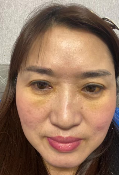 ☆怎么治眼袋保质期更好?哪里可以做?046 ☆怎么治眼袋保质期更好?哪里可以做?046