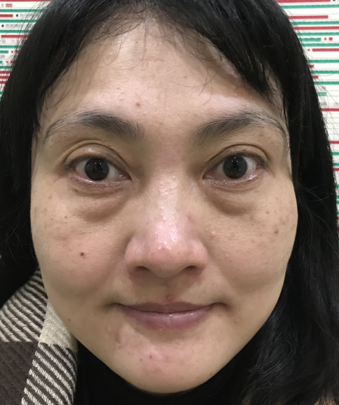 去眼袋手术