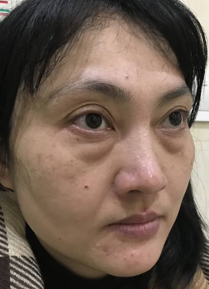 去眼袋手术