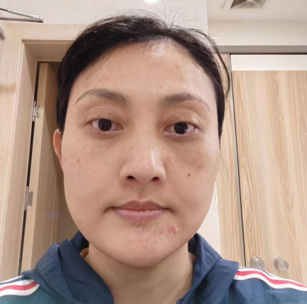 去眼袋手术