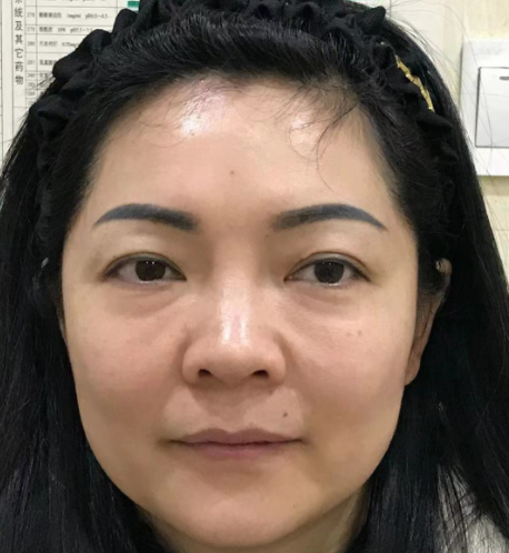 去眼袋手术