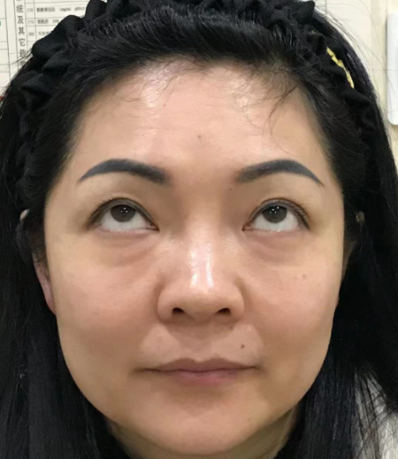 去眼袋手术