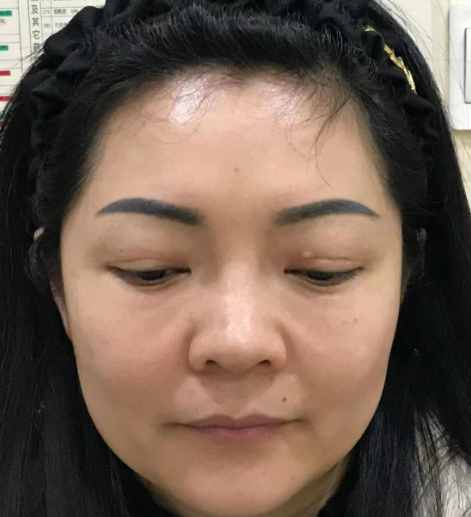 去眼袋手术