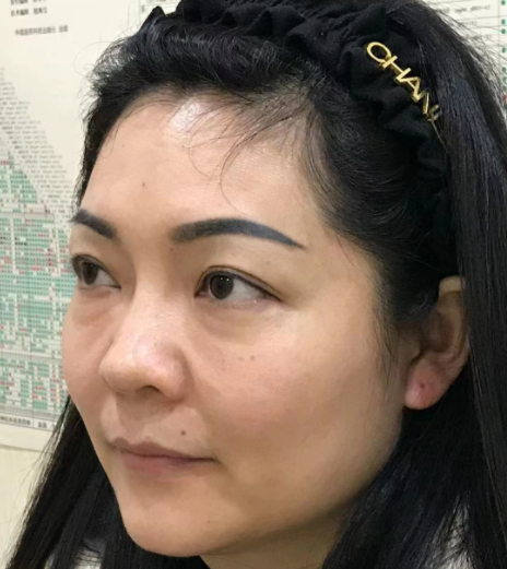 去眼袋手术
