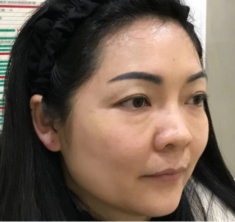 去眼袋手术