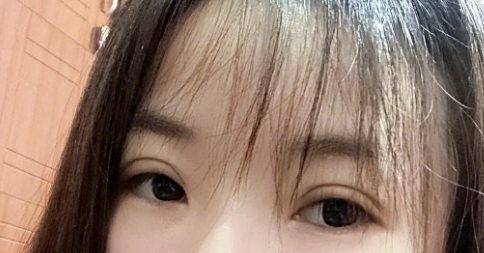 双眼皮手术