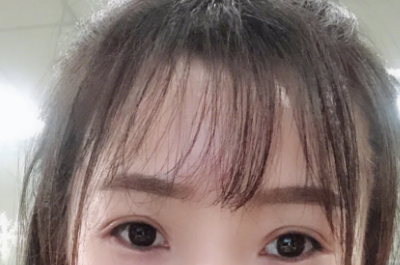 双眼皮手术