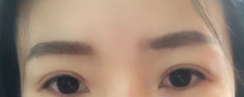 双眼皮手术