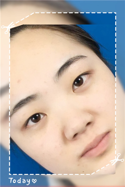 双眼皮手术