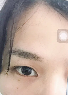 双眼皮手术