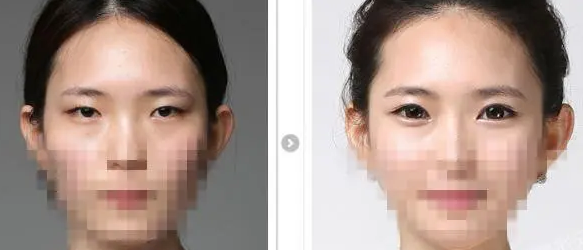 双眼皮